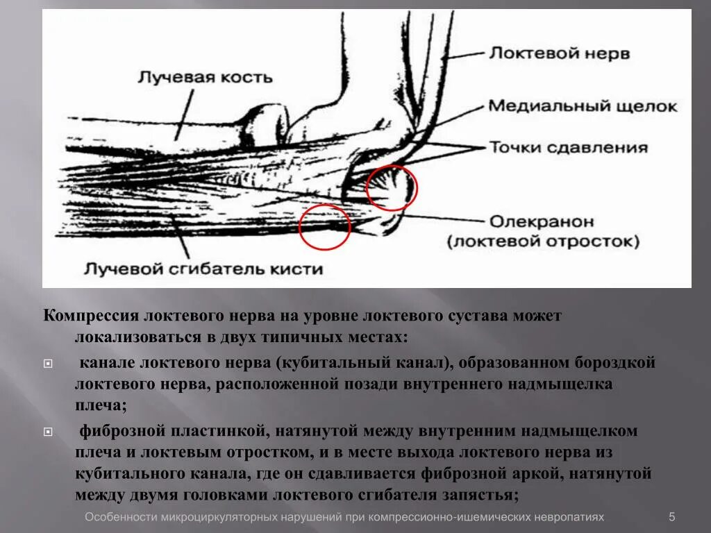 Невропатия лучевого нерва мкб