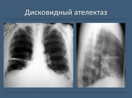 Легкое уменьшено