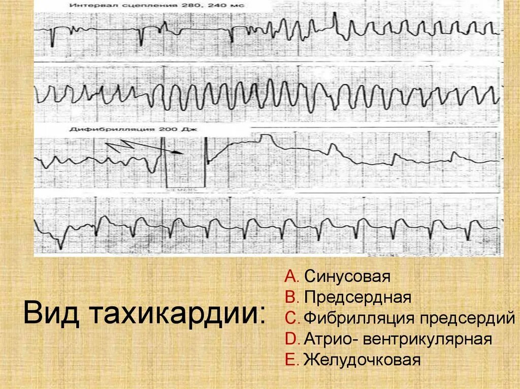 Синусовая тахикардия вертикальное. Желудочковая тахикардия при фибрилляции предсердий. Синусовая и предсердная тахикардия. Фибрилляция предсердий и предсердная тахикардия. Пароксизмальная тахикардия трепетание предсердий.