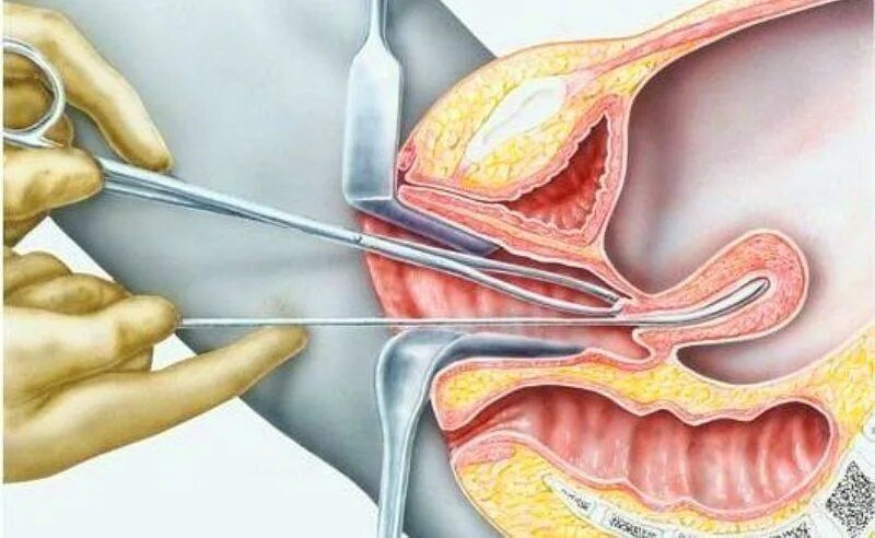 Хирургическое выскабливание полости матки. Бужирование цервикального канала. Зондирование матки и диагностическое выскабливание. Выскабливание как проводится
