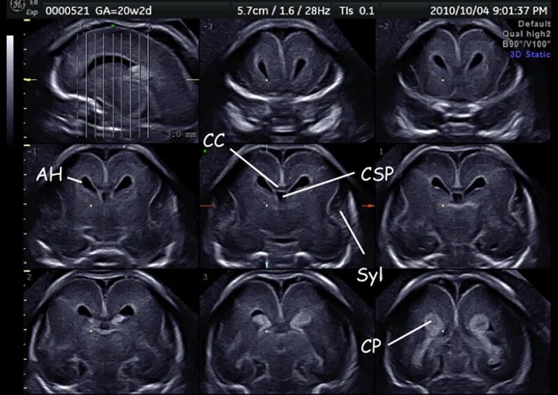 УЗИ головного мозга нейросонография. УЗИ желудочков головного мозга плода. Агенезия боковых желудочков. Боковые желудочки на УЗИ.