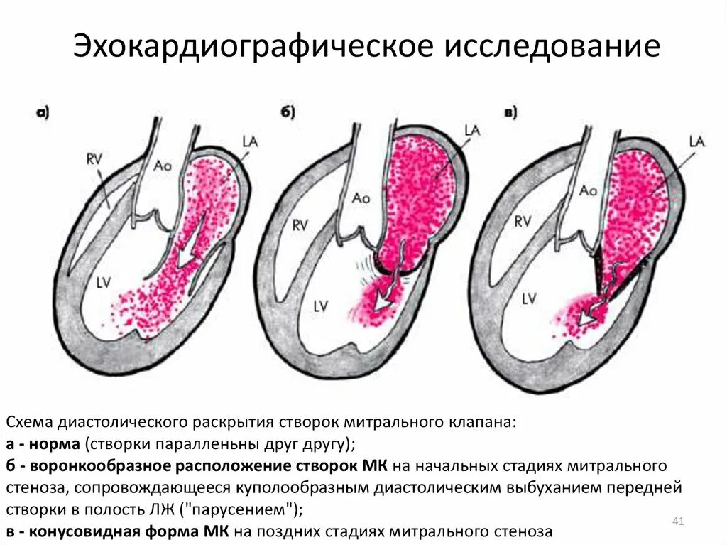 Митральный стеноз признаки. Патогенез митральной недостаточности схема. Митральная недостаточность гемодинамика пропедевтика. Патогенез митрального стеноза схема. Митральный стеноз и митральная недостаточность.