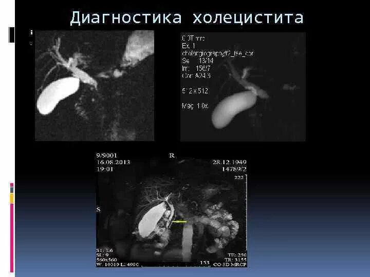 Диагноз калькулезный холецистит. Лабораторные методы диагностики холецистита. Методы инструментальной диагностики острого холецистита. Калькулезный холецистит лабораторная диагностика. Холецистит инструментальные  диагностика.