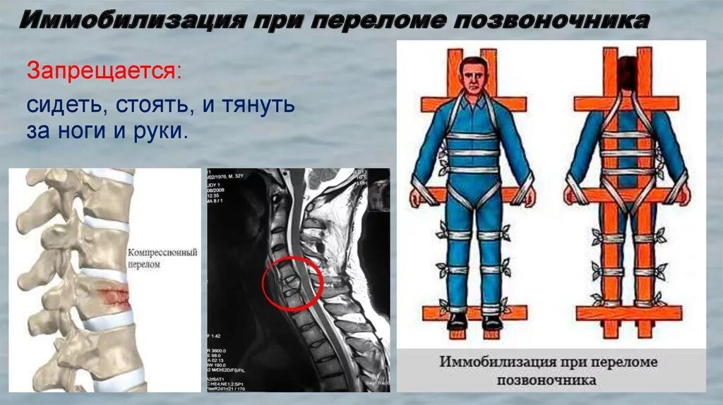 Повреждение позвоночника необходимо. Перелом позвоночника иммобилизация. ПМП при переломе костей позвоночника. Перелом поясничного отдела позвоночника иммобилизация. Перелом позвоночника компрессионный ПМП.