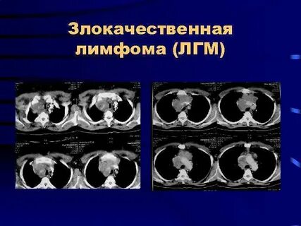 Злокачественные лимфомы