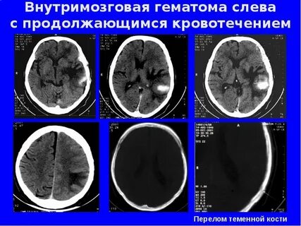Черепно мозговая травма гематома