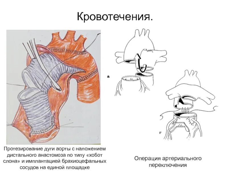 Операция протезирование аорты. Операция борста хобот слона. протезирование дуги аорты. протез восходящей аорты. операция протезирования аорты.