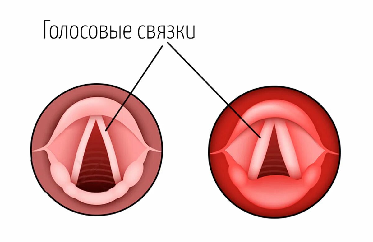 Ларингит симптомы у детей до года. Острый катаральный ларингит при ларингоскопии. острый катаральный ларингит у детей. острый и хронический ларингит.