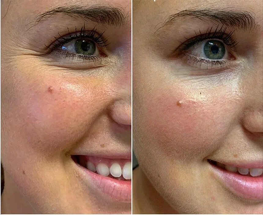 Лицо после ботулинотерапии. Осложнения ботулинотерапии. Ботулинотерапия межбровья. Результат после ботулинотерапии. Релатокс ботокс.