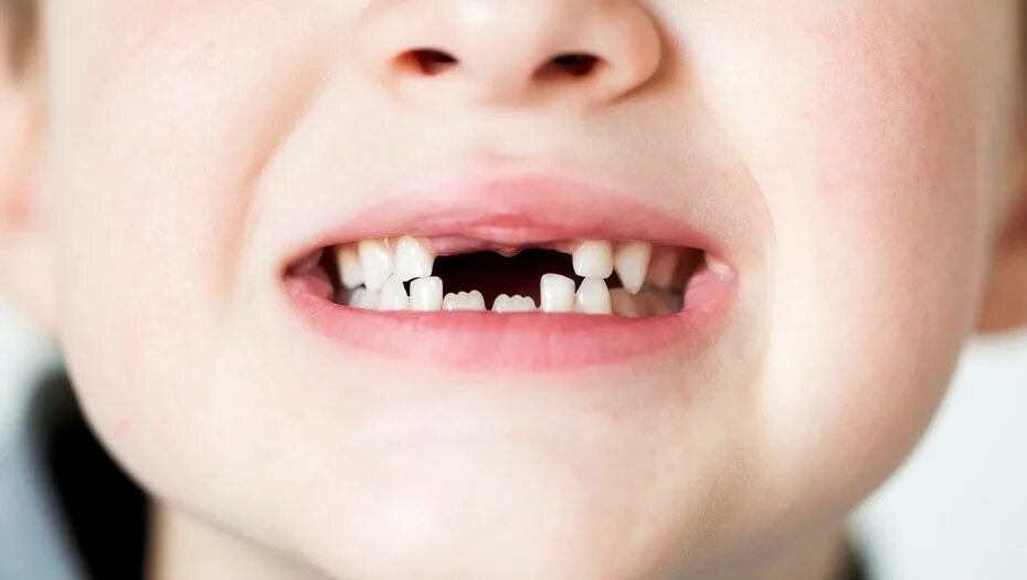 4 года зубы выпадают. Резцы зубов у детей.