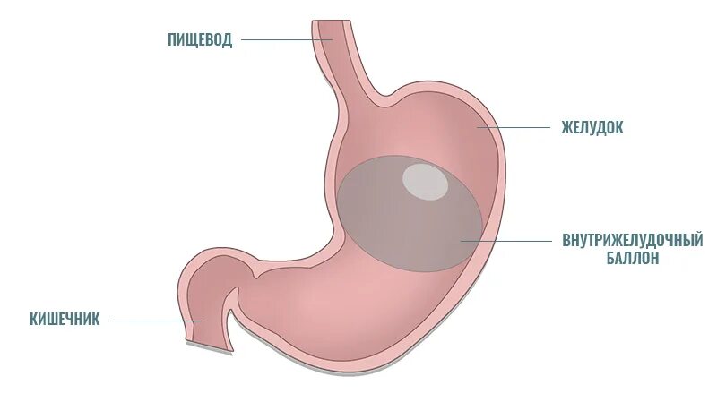 Внутрижелудочный баллон. Как ощущается желудок