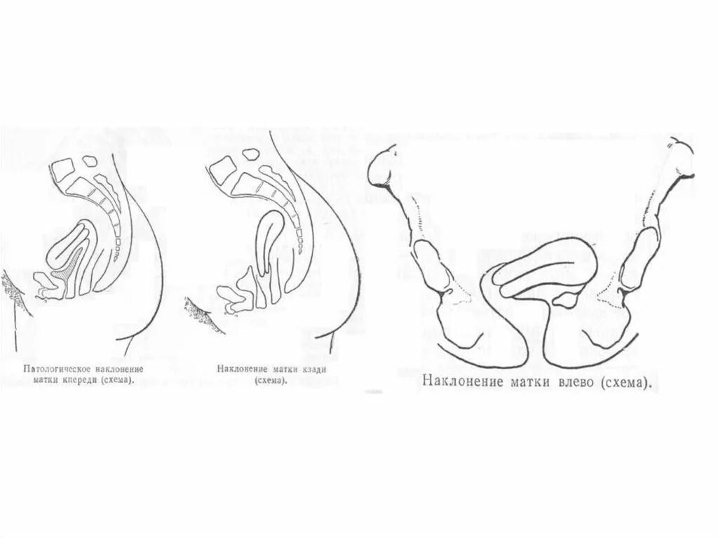 Расположение шейки матки кзади. Загиб матки кзади. Загиб тела матки кпереди.