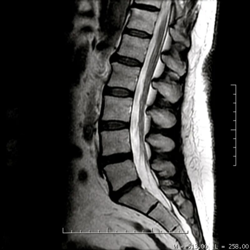 Мрт спинного отдела. Мрт пояснично-крестцового отдела позвоночника. Мрт крестцового отдела позвоночника. Мрт пояснично-крестцового отдела норма. Снимки мрт пояснично-крестцового отдела позвоночника.