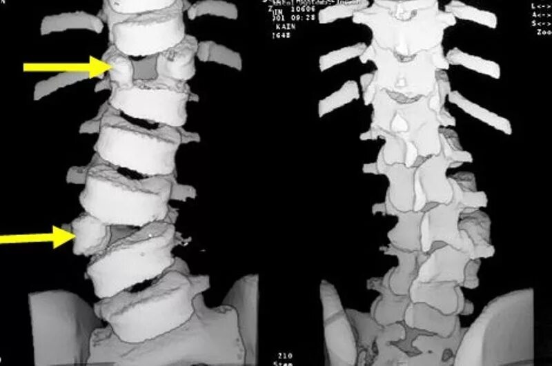 Аномалия развития позвонков грудного отдела. Что такое сколиоз шейного отдела позвонка. Клиновидная деформация th7 позвонка. Позвонки th7-l2.