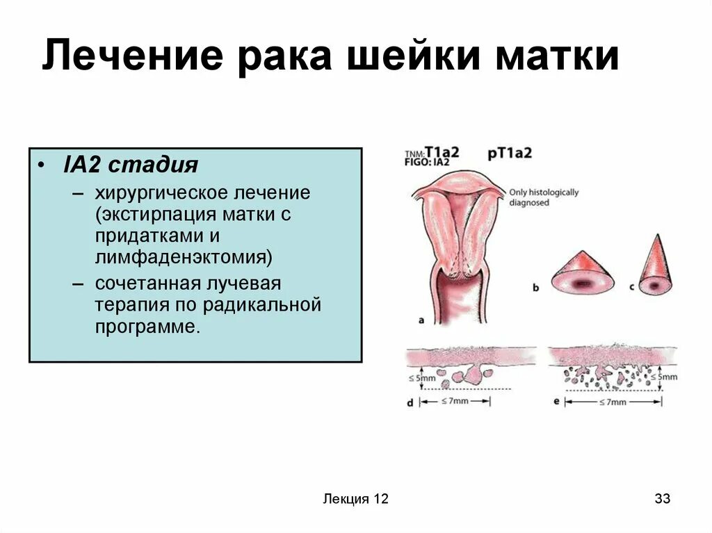 Коническая форма шейки матки. Ранние симптомы онкологии шейки матки. Онкология матки лечение