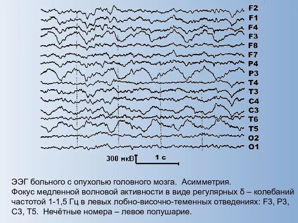 Голов показывать ээг. Волны на ээг расшифровка. нормальная диаграмма ээг. электроэнцефалограмма головного мозга норма. электроэнцефалография (ээг) исследование электрической активности.