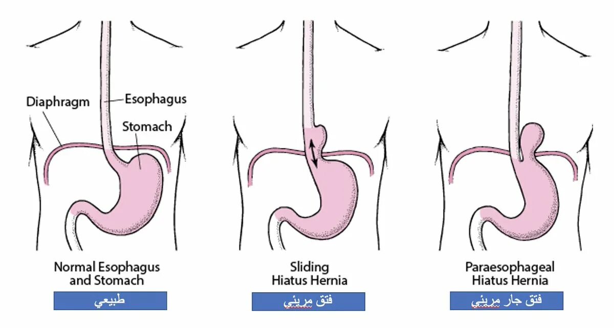 ГЭРБ грыжа пищеводного отверстия диафрагмы. Скользящая грыжа в желудке операция. Грыжа пищеводного отверстия диафрагмы операция. Хиатальная грыжа желудка что это.