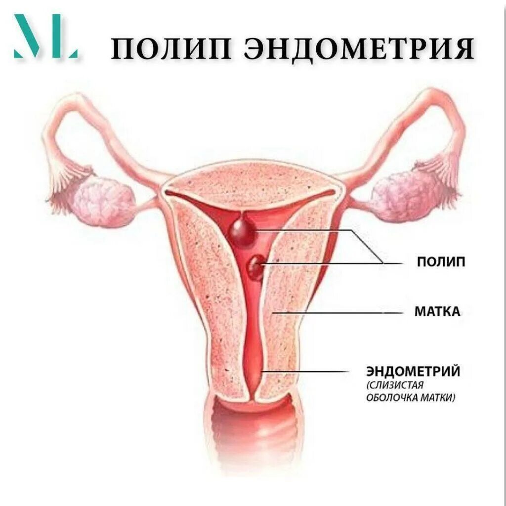 Эндометриальный полип. Слизистая оболочка матки эндометрий. Полипоз эндометрия матки.