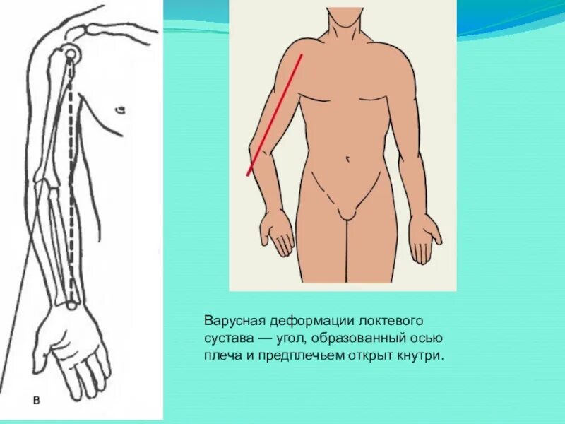 Деформация предплечья. Варусная деформация локтевого сустава. искривление предплечья варусная. вальгусная деформация локтевых суставов. деформация верхней конечности.