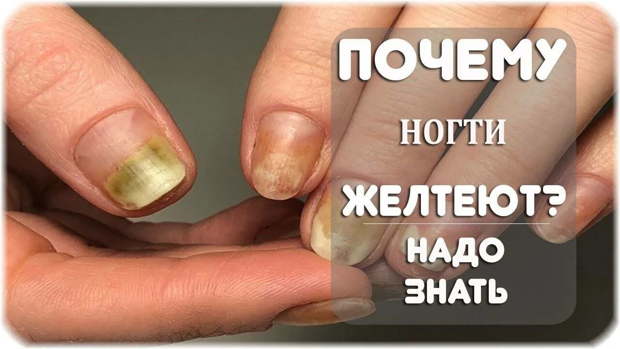 Жёлтые ногти от курения. Почему желтеют руки причина