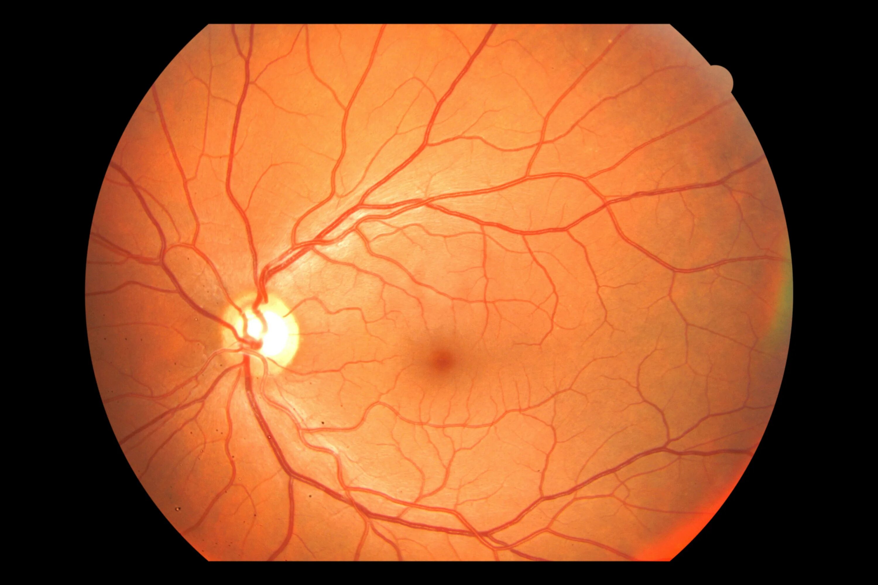 Изменение на глазном дне. Центральная хориоретинальная дистрофия сетчатки. Ишемическая нейропатия зрительного нерва. Зрительный нерв глаукома. Передняя ишемическая нейропатия.
