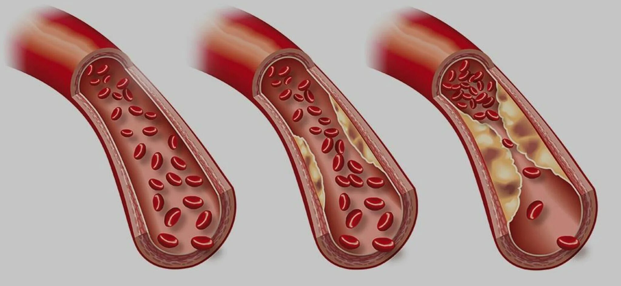 Кровь закупорка сосудов. Холестериновые бляшки в сосудах. Холестерин бляшки в сосудах. Кровеносный сосуд с холестерином.
