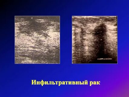 Инфильтрирующая карцинома
