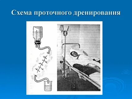Дренирование антисептика