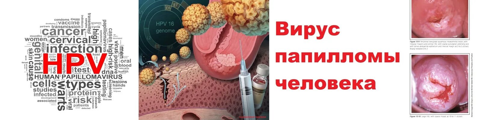 Как вылечить вирус папилломы человека. Как вылечить вирус папилломы человека