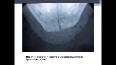 Клинические рекомендации перелом нижней челюсти