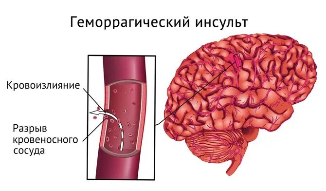 Типы геморрагического инсульта. Инсульт без кровоизлияния. Ґоморрогический инсульт. Геморрагический инсульт. Факторы риска.
