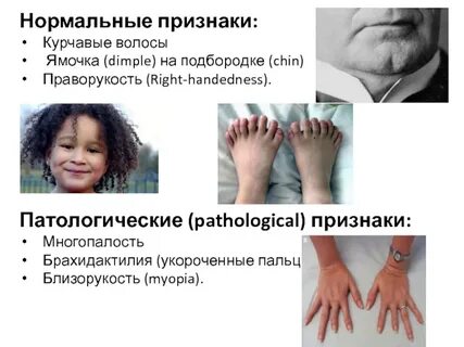 Праворукость у человека аутосомный доминантный