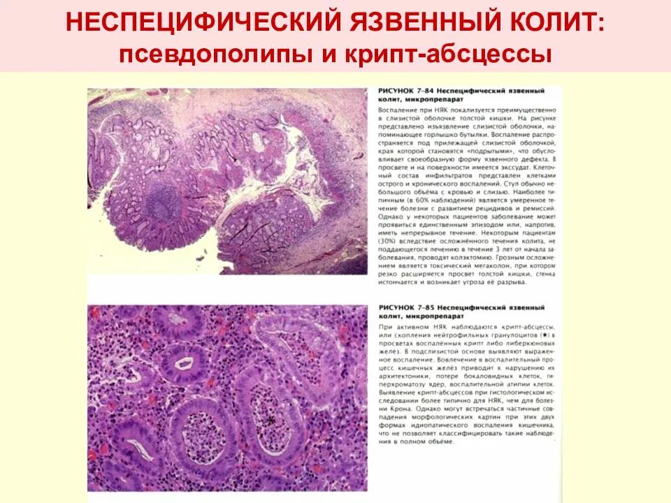 Неспецифический язвенный колит патоморфология. Неспецифический язвенный колит патанатомия микропрепарат. Язвенный колит макропрепарат. Болезнь крона патанатомия микропрепарат.