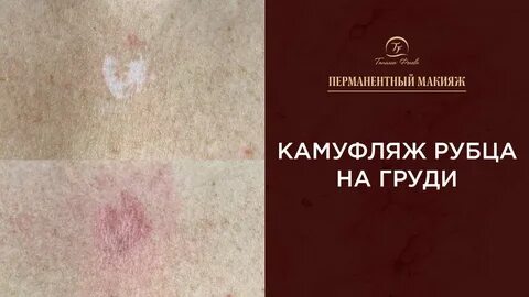 Камуфляж рубца