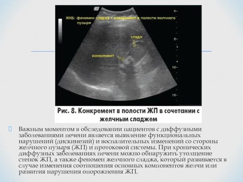 Диффузные изменения стенок желчного пузыря. Жировая инфильтрация печени узи. жировая инфильтрация желчного пузыря. утолщение стенки желчного пузыря на кт. стенка передняя в желчном пузыре по узи.