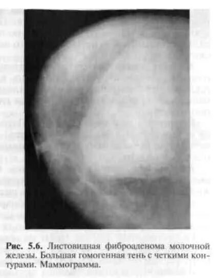 Фиброаденома молочной железы что это лечение. Филлоидная фиброаденома молочной железы гистология. Листовидная фиброаденома молочной железы гистология. Фиброаденома молочной железы маммограмма. Листовидная форма фиброаденомы молочной железы.
