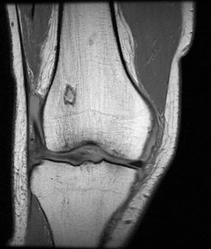 Отек мыщелка бедренной. Инфаркт кости коленного сустава кт. Асептический некроз большеберцовой кости коленного сустава кт. Инфаркт кости коленного сустава мрт. Инфаркт костного мозга большеберцовой кости коленного сустава.