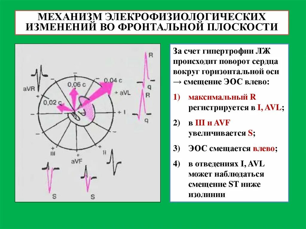 Вертикальная позиция сердца. Электрическая ось сердца (ЭОС) на ЭКГ. Электрическая ось сердца на ЭКГ угол Альфа. Электрическая ось сердца во фронтальной плоскости. Понятие об электрической оси сердца во фронтальной плоскости..