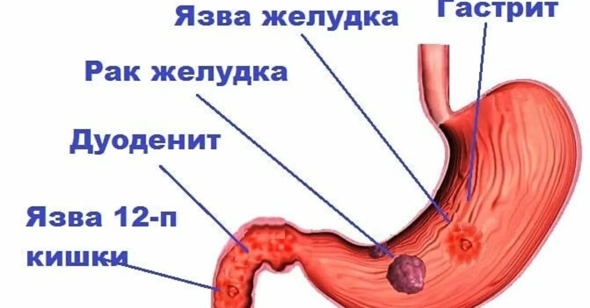 Как отличить язву