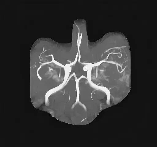 Виллизиев круг вариант развития на мрт. Виллизиев круг мрт. Кт Виллизиева круга. Сегменты Виллизиева круга мрт. Виллизиев круг сегменты мрт.