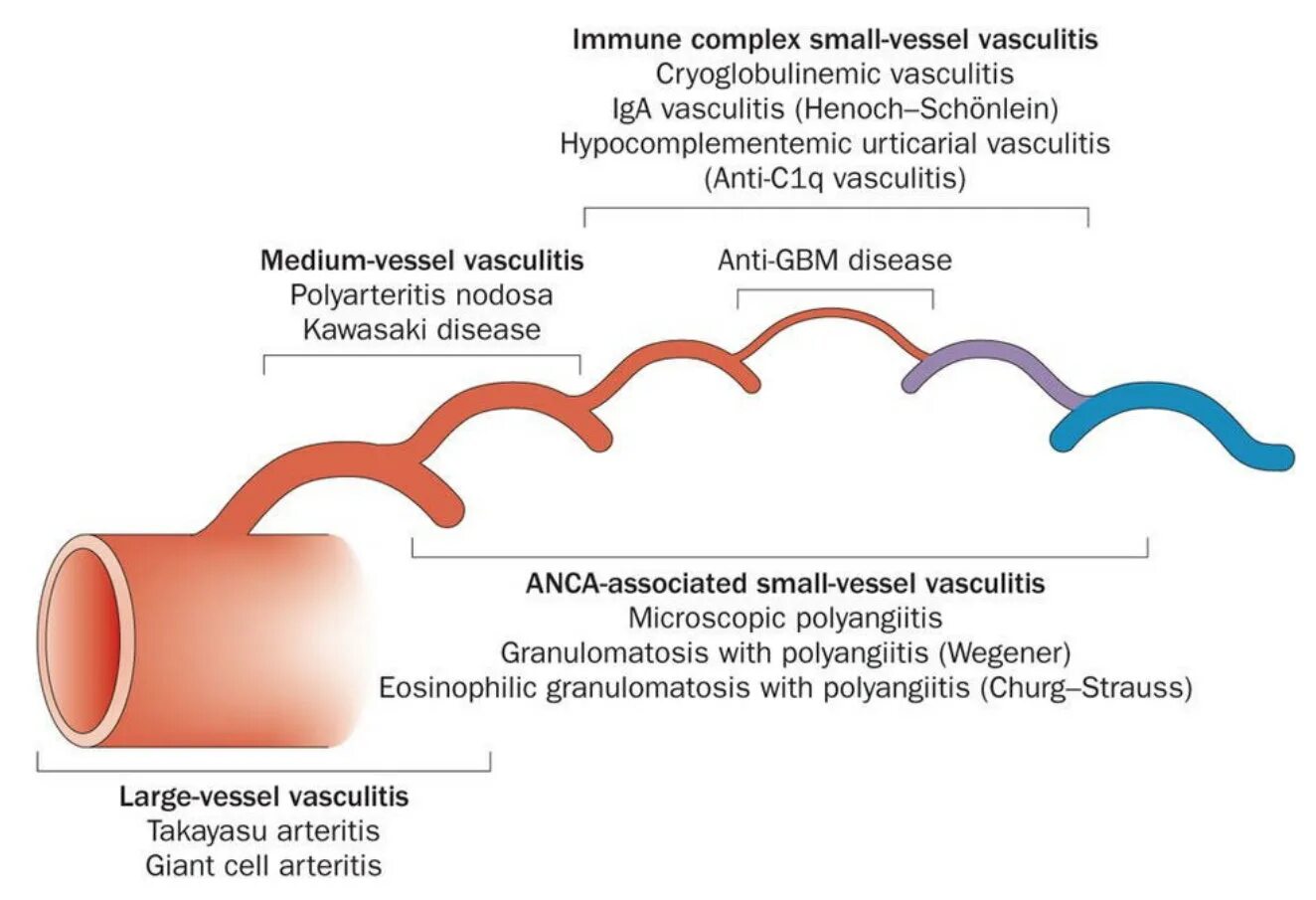Васкулит патогенез. Системные васкулиты классификация. Системные васкулиты патогенез. Васкулит классификация что это такое. Васкулиты классификация Чапел.