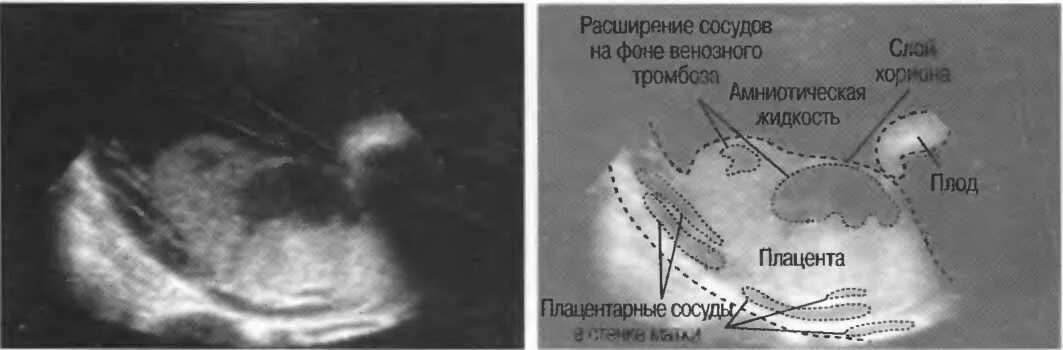 Отслойка хориона на ранних сроках. Эхография отслойки плаценты.