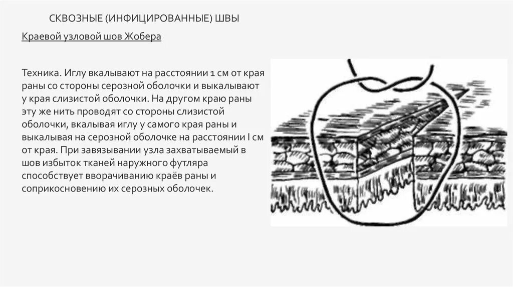 Стерильный шов. Краевой Узловой шов Жобера. Кишечный шов Пирогова черни. Шов Жобера кишечный.