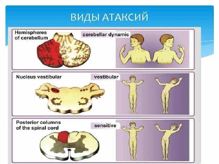 Вестибуло атаксический синдром. Вестибуло мозжечковая атаксия. Атаксия Фридрейха болезнь. Мозжечковая атаксия Фридрейха. Вестибуло мозжечковый синдром.