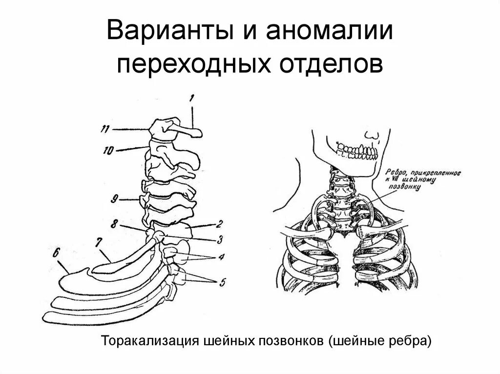 Аномалии костей. Аномалии костей туловища. аномалии развития крестца. переходные позвонки.