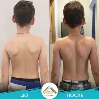 Виды горбов