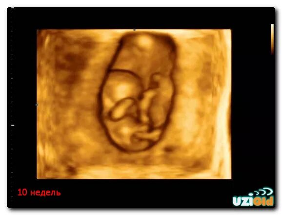 Беременность узи недели беременности видео. УЗИ 10 недель беременности 4д. 10 Недель беременности видео УЗИ. 3д УЗИ на 10 неделе беременности. Эмбрион на 10 неделе беременности УЗИ.