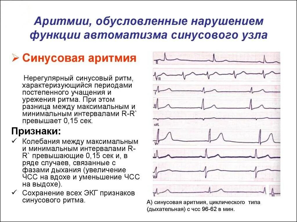 Аритмия при нормальном давлении и пульсе. Синусовая мерцательная аритмия экг. неправильный синусовый ритм на экг. показатели экг при синусовой аритмии. синусовая аритмия после нагрузки на экг.