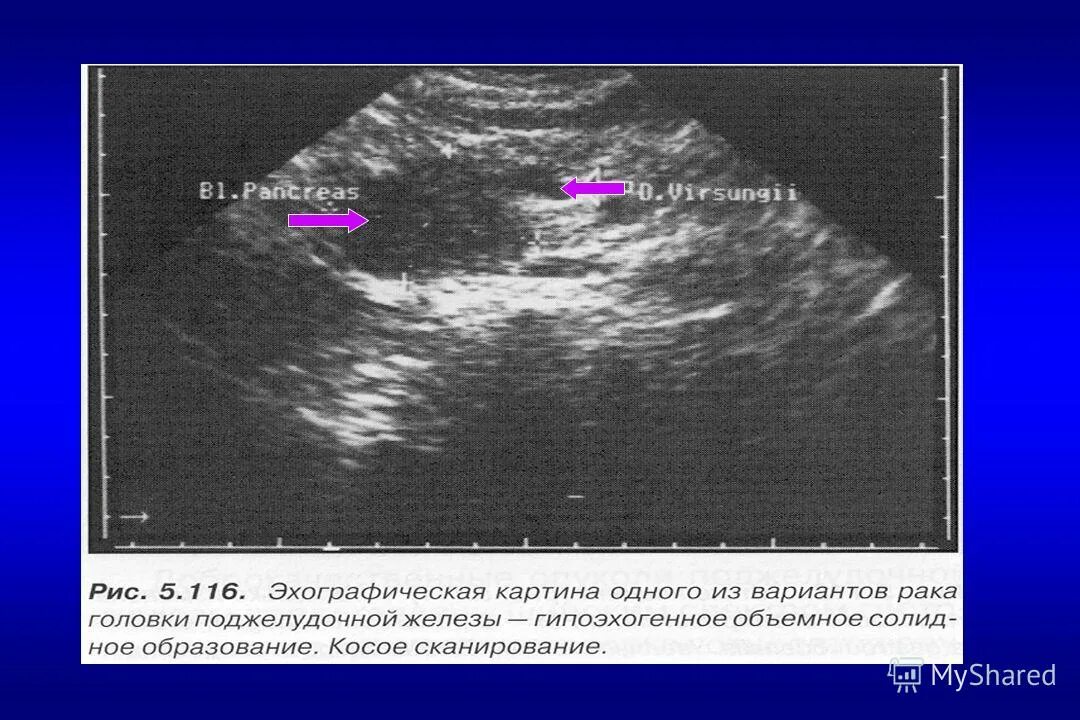 гипоэхогенное образование в печени на узи что