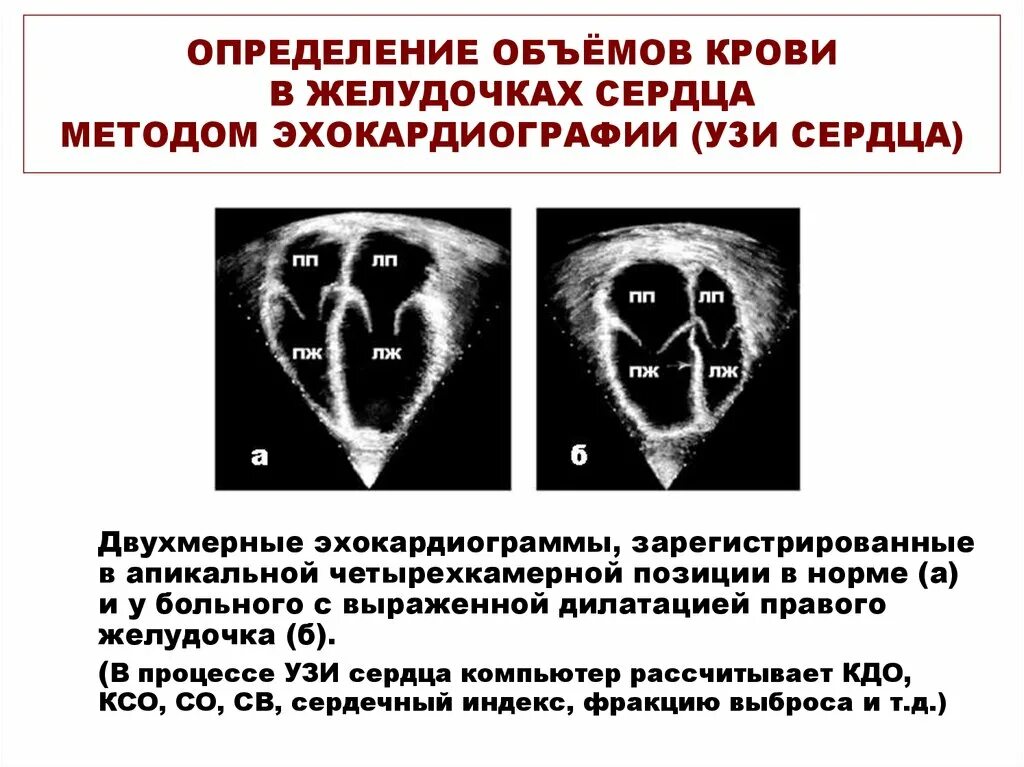Увеличение объема желудочков сердечный выброс. Объем желудочков сердца. измерение правого желудочка на узи сердца-. определить ударный объем левого желудочка..